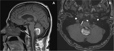 Case Report: Endovascular Treatment of a Giant Distal PICA Aneurysm in Association With a Cerebellar AVM: A Report on Treatment Considerations and a Literature Review